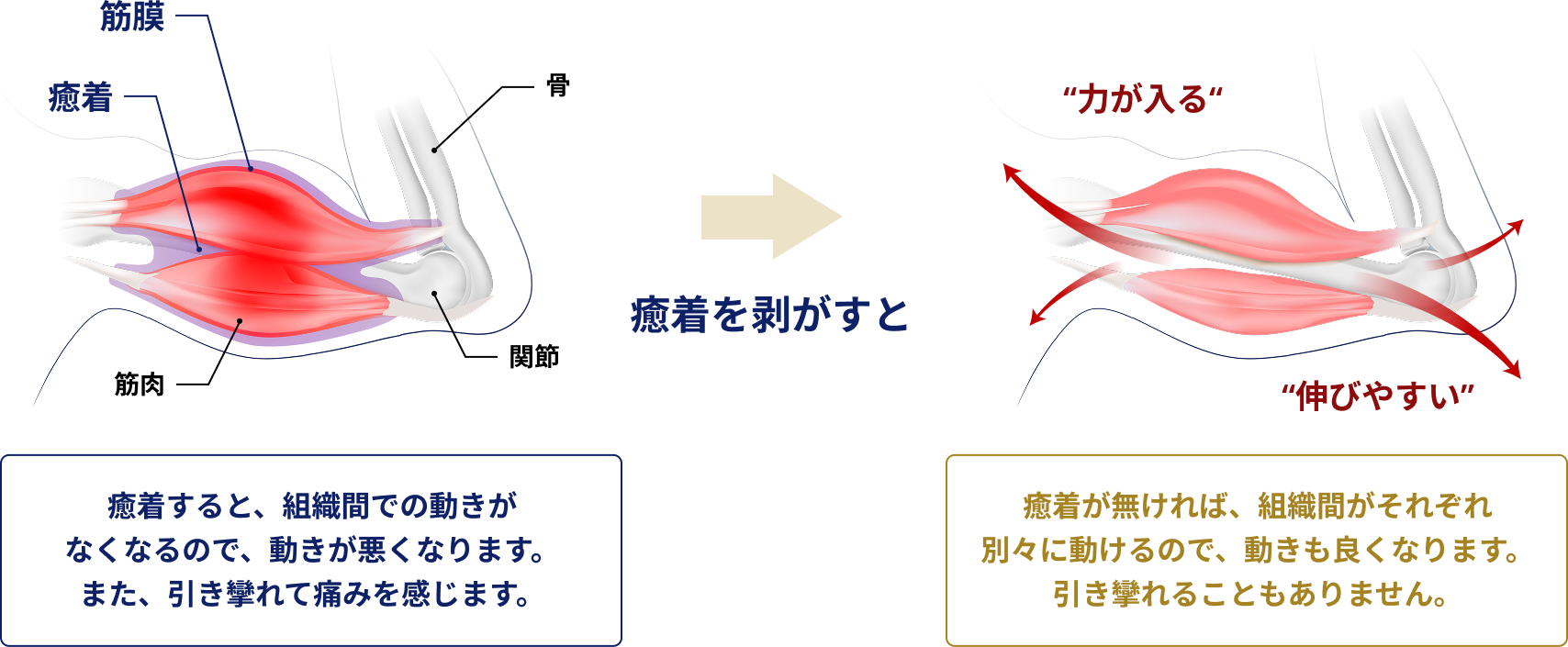 筋膜の癒着の図解