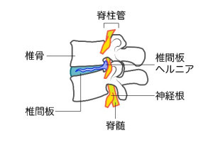 椎間板ヘルニアの構造の画像
