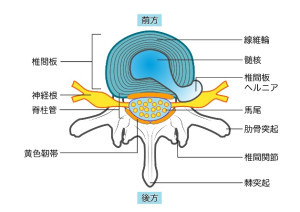 椎間板ヘルニアの構造図(断面)