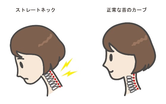 ストレートネックと正常な首の比較画像