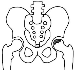 大腿骨頭壊死の図解