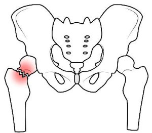 大腿骨頭頚部骨折の図解